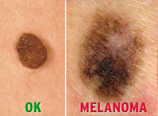 Foto: https://www.melanomacenter.com/whatis/melanoma_slideshow.html